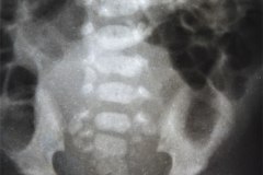 anomalia-sacro-y-articulacion-sacroiliaca-mar-1994-001