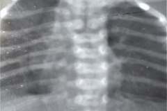 anomalia-vertebral-cervical-toracica-raquisquisis-escoliosis-1988-000