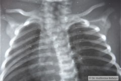 anomalia-vertebral-cervical-toracica-raquisquisis-escoliosis-1988-001