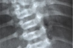 anomalia-vertebral-multiple-raquisquisis-vertebra-en-mariposa-hemivertebra-escoliosis-1994-001
