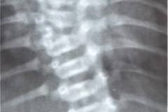 anomalia-vertebral-multiple-raquisquisis-vertebra-en-mariposa-hemivertebra-escoliosis-1994-002