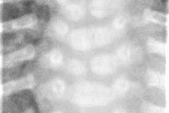 anomalia-vertebral-multiple-000