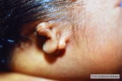 anotia-000