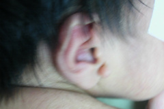 apendice-pre-auricular-der-2003-000