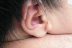 apendice-pre-auricular-der-2003-001