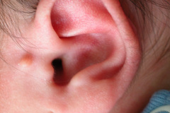 apendice-preauricular-bil-2004-000