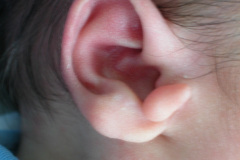 apendice-preauricular-bil-2004-002