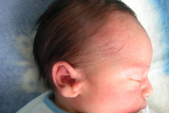 apendice-preauricular-bil-2004-006