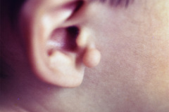 apendice-preauricular-der-1989_09-000