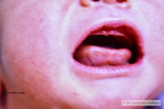 apendice-yugal-mucosa-bucal-mejilla-izq-000