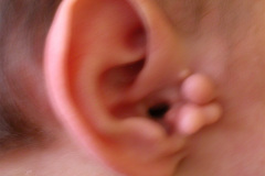 apendices-preauriculares-bil-2010-000