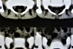 aplasia-cutis-lumbar-mielomeningocele-oculto-1a4m-tac-1991-000