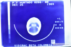 aplasia-cutis-004