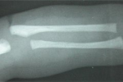 aquiria-agenesia-mano-izq-000