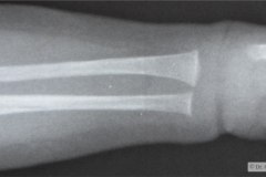 aquiria-agenesia-mano-izq-1991-002