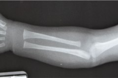 aquiria-agenesia-mano-izq-1991-003