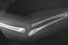 aquiria-agenesia-mano-izq-1995-000