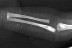 aquiria-agenesia-mano-izq-1995-001