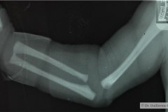 aquiria-agenesia-mano-izq-2010-002