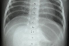 arnold-chiari-cavidad-medular-cervical-amplia-mielomeningocele-000