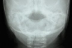 arnold-chiari-cavidad-medular-cervical-amplia-mielomeningocele-001
