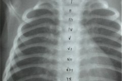 arnold-chiari-cavidad-medular-cervical-amplia-mielomeningocele-002