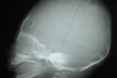 arnold-chiari-cavidad-medular-cervical-amplia-mielomeningocele-003