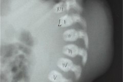 arnold-chiari-cavidad-medular-cervical-amplia-mielomeningocele-004