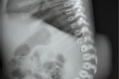 arnold-chiari-cavidad-medular-cervical-amplia-mielomeningocele-005