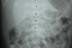 arnold-chiari-cavidad-medular-cervical-amplia-mielomeningocele-006