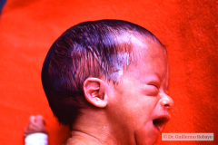 arnold-chiari-ii-hidrocefalia-mielomenigocele-y-postop-000