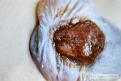arnold-chiari-ii-hidrocefalia-mielomeningocele-1988-008