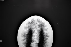 arnold-chiari-ii-hidrocefalia-mielomeningocele-plejos-coroideos-ecografia-tac-1995-002