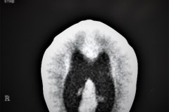 arnold-chiari-ii-hidrocefalia-mielomeningocele-plejos-coroideos-ecografia-tac-1995-003