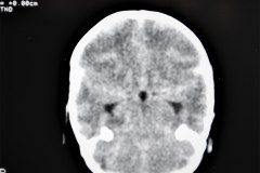 arnold-chiari-ii-hidrocefalia-mielomeningocele-plejos-coroideos-ecografia-tac-1995-005