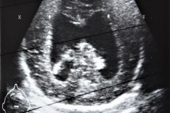 arnold-chiari-ii-hidrocefalia-mielomeningocele-plejos-coroideos-ecografia-tac-1995-006