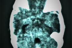 arnold-chiari-ii-hidrocefalia-mielomeningocele-tac-2010-001