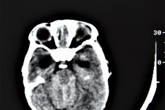 arnold-chiari-ii-mielomeningo-hidrocefalia-dvp-rn5d12d-1992-001