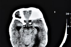 arnold-chiari-ii-mielomeningo-hidrocefalia-dvp-rn5d12d-1992-002