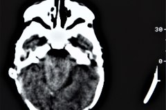 arnold-chiari-ii-mielomeningo-hidrocefalia-dvp-rn5d12d-1992-003