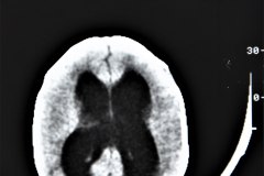 arnold-chiari-ii-mielomeningo-hidrocefalia-dvp-rn5d12d-1992-007