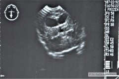 arnold-chiari-ii-mielomeningo-hidrocefalia-dvp-rn5d12d-1992-012
