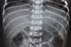 arnold-chiari-ii-mielomeningo-hidrocefalia-dvp-rn5d12d-1992-018