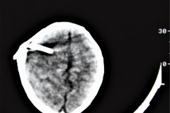 arnold-chiari-ii-mielomeningo-hidrocefalia-dvp-rn5d12d-1992-020