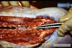 arnold-chiari-ii-mielomeningocele-lumbar-1986-001