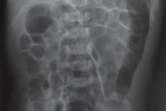 asa-intestinal-fija-enterocolitis-ecn-bell-ib-1988-001