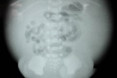 asas-intestinales-centrales-ascitis-000