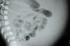 asas-intestinales-centrales-ascitis-001