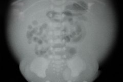ascitis-congenita-2002-000