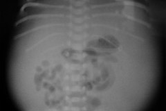 ascitis-congenita-2002-001